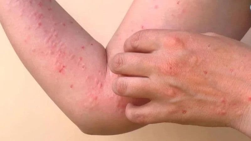 Chikungunya Outbreak Hits Mombasa as Rains Fuel Mosquito Surge