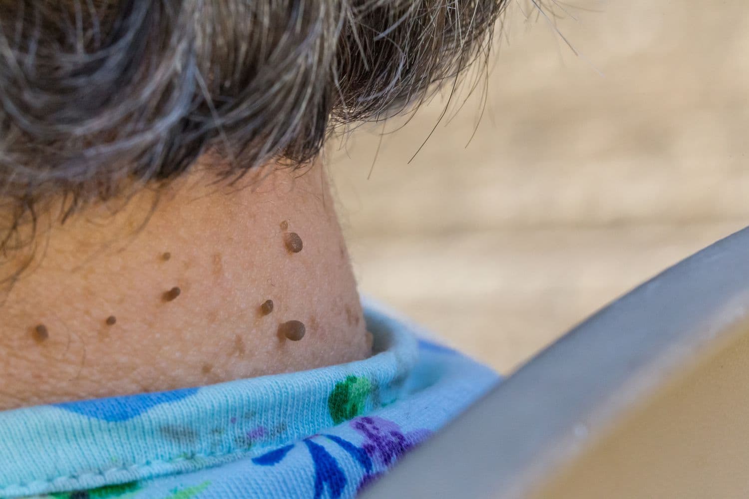 Understanding Skin Tags: Causes, Characteristics, and Treatment Options